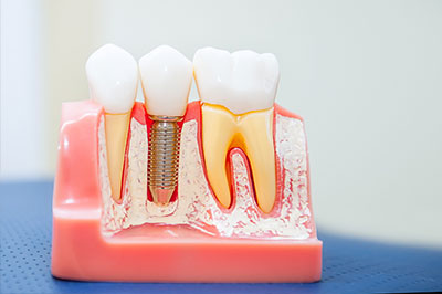 Durham Dental Studio | Dental Bridges, Implant Restorations and Periodontal Treatment